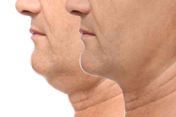 HIFU - Breakthrough in Anti - ageing 2 hifu results Weybridge