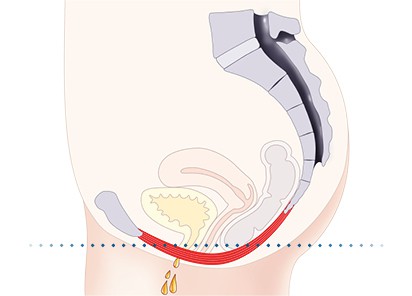 Pelvic-Floor Muscle Repair 5 Pelvic floor muscles Weybridge