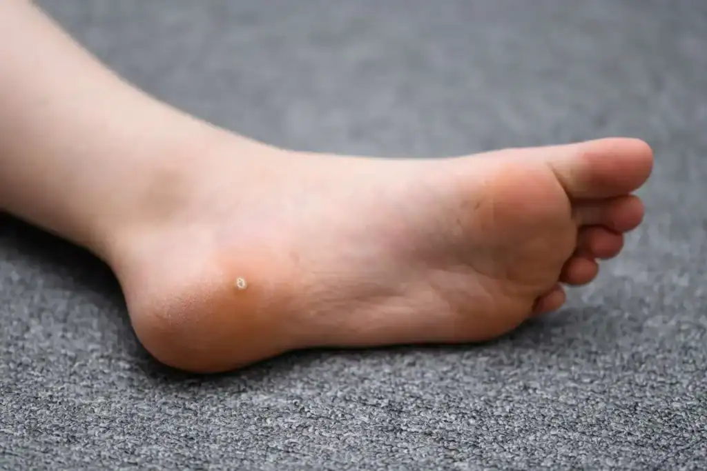 Cryotherapy For Warts And Also Verrucas 2 Image of verruca on the bottom of the foot that able to be treated with Cryotherapy Weybridge
