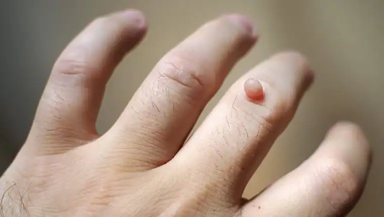 Image of blemish that Cryotherapy Weybridge can remove with Lipo 360.