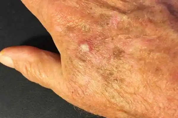 Image of Actinic keratoses Weybridge on a person hand